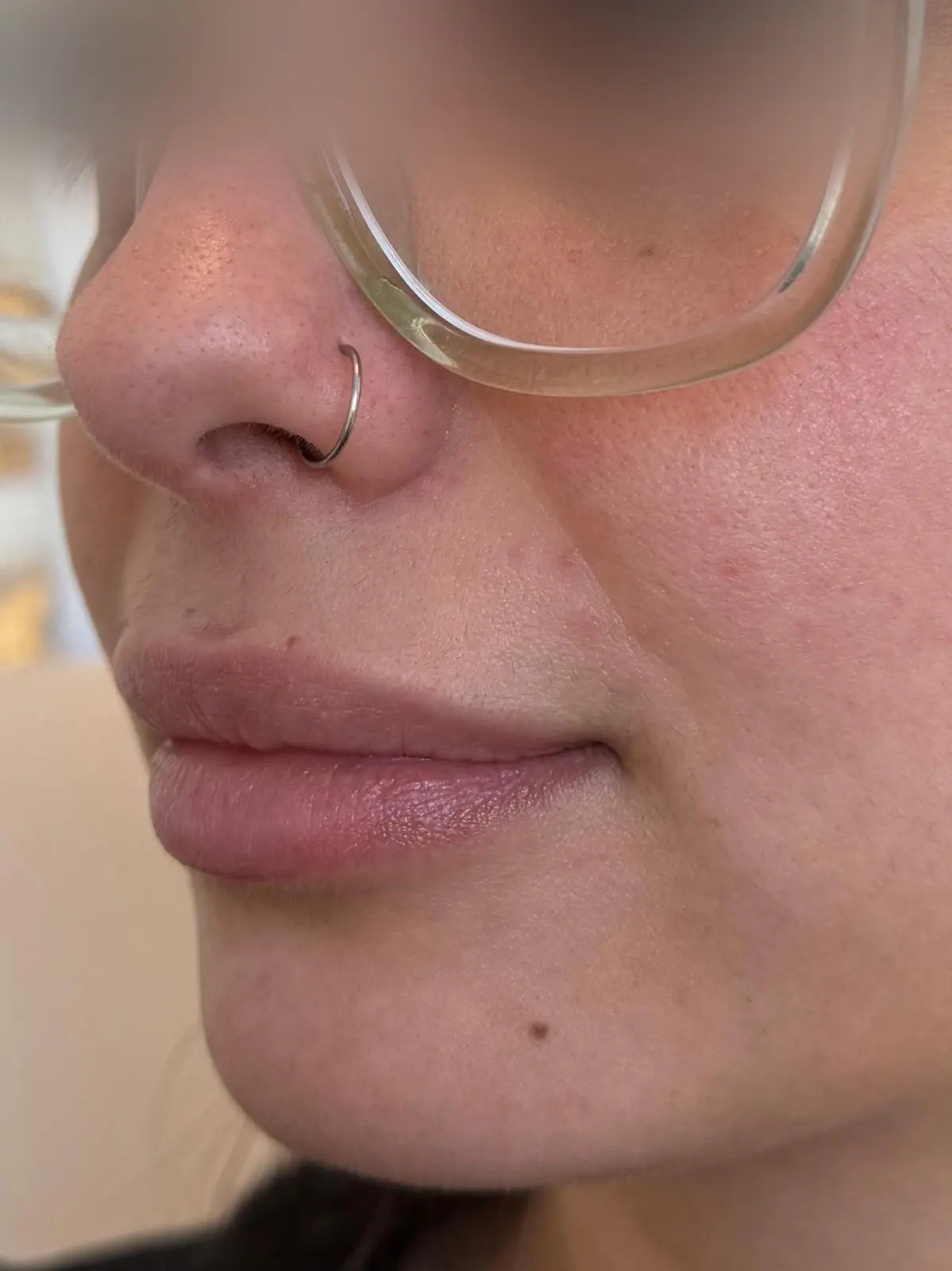 Lip Enhancement Before