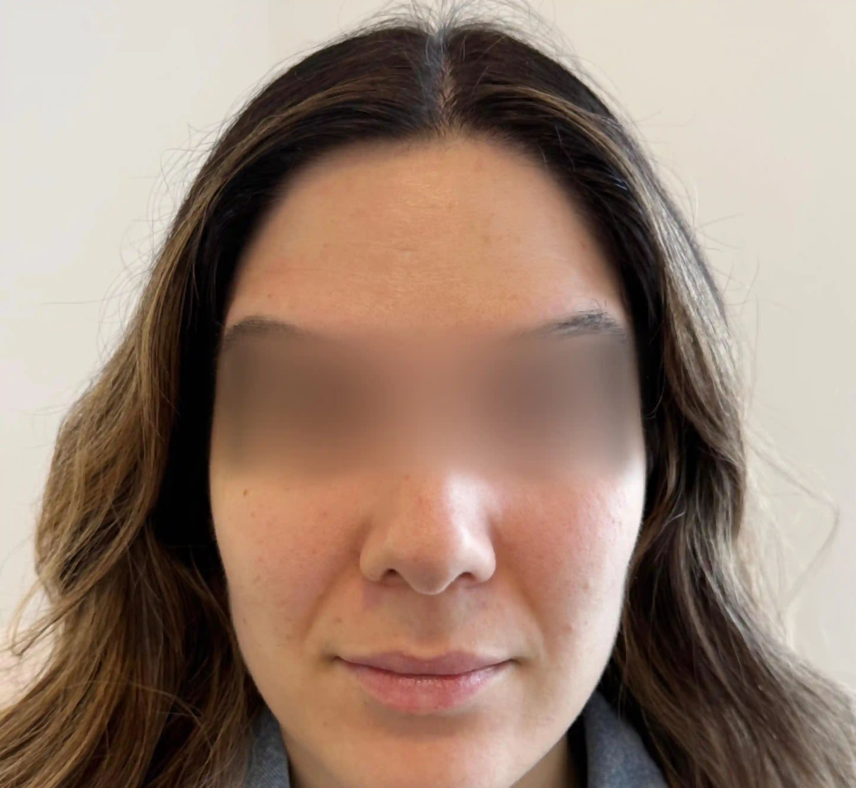 Forehead After